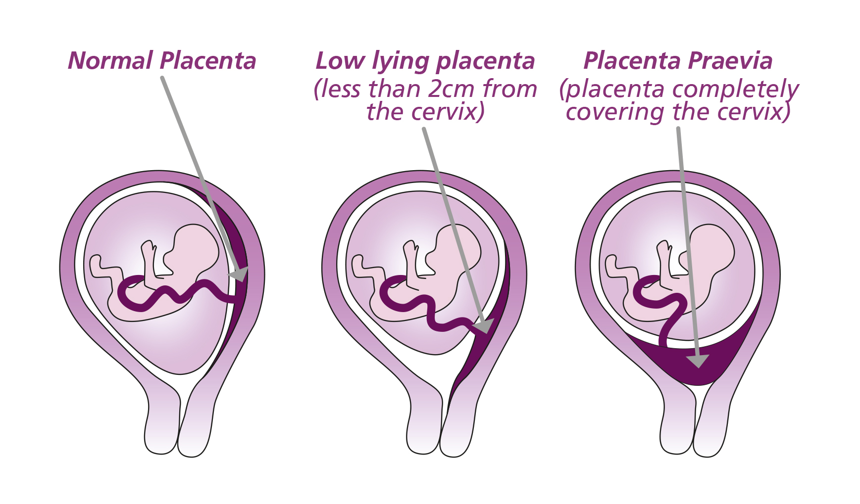 Placenta Praevia, Placenta Accreta And Vasa Praevia - Leeds Teaching ...