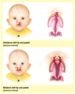 About cleft lips and palates - Leeds Teaching Hospitals NHS Trust