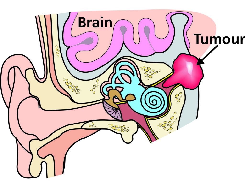 A diagram showing a tumour putting pressure on the eighth cranial nerve.