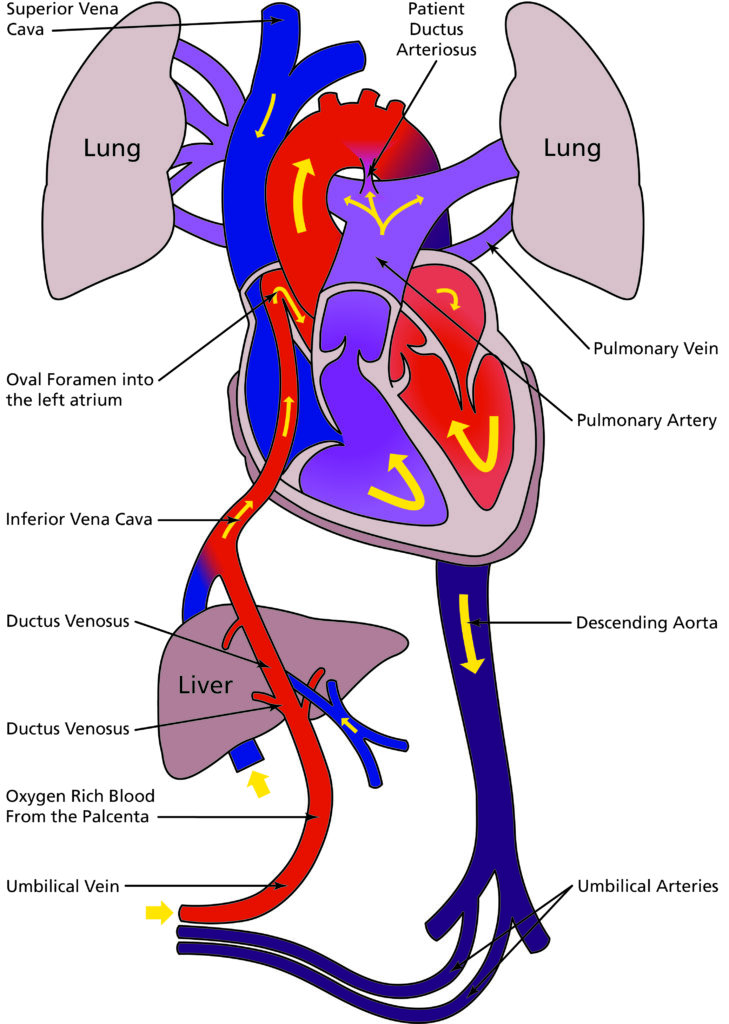 Patent Ductus Arteriosus (PDA) in newborn Infants - Leeds Teaching ...