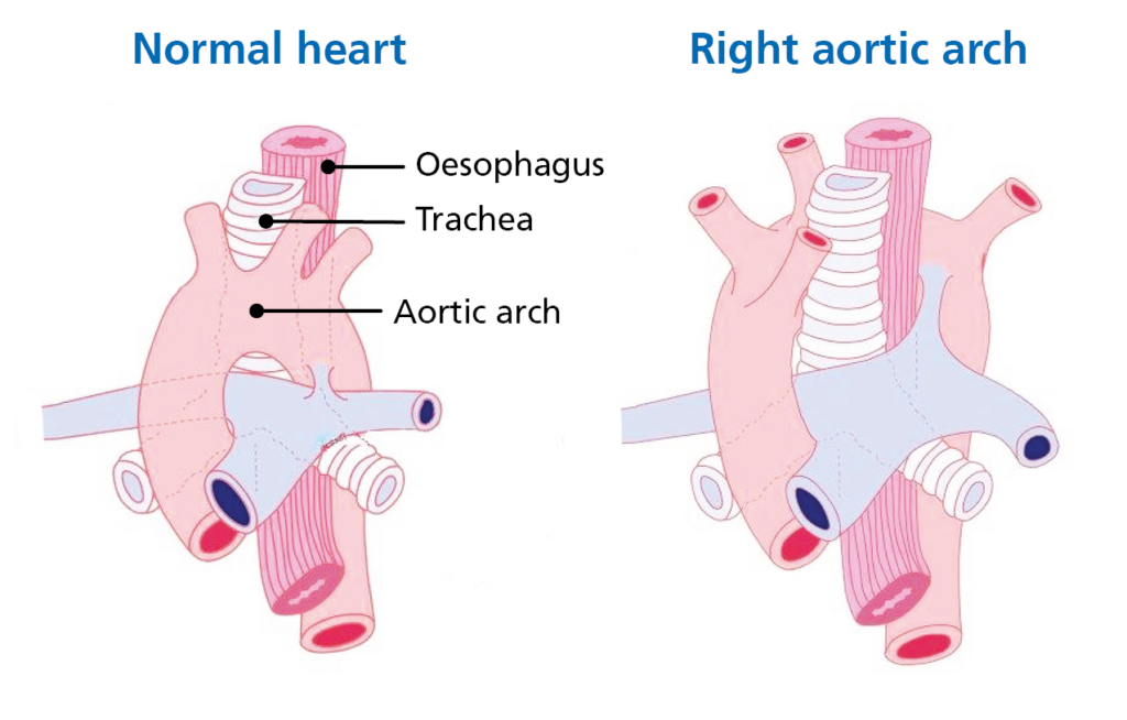 Image shows a normal heart on the left and a heart with a right aortic arch on the right