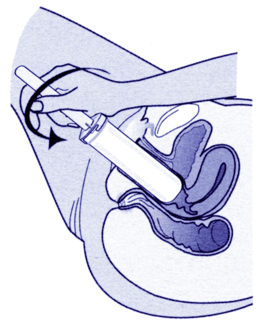 An illustration showing a cross section of the lower body with the dilator being rotated.