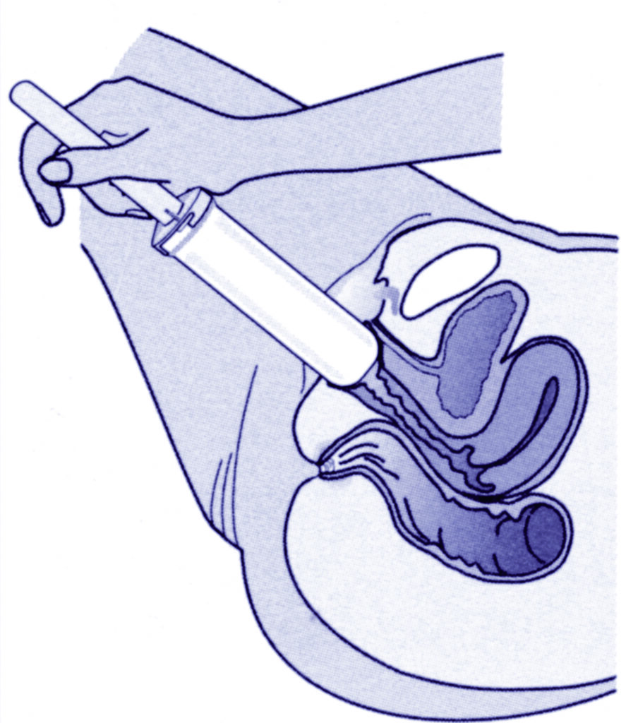 An illustration showing a cross section of the lower body with the dilator being inserted.