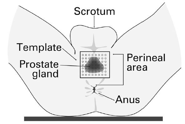 An image showing the position of the template.