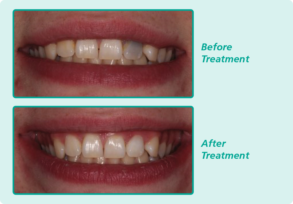 Two photographs of the same teeth before and after treatment. After treatment the teeth are whiter.