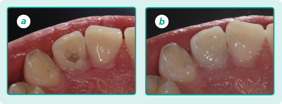 Two photographs of the back of the same tooth. In the first photograph (a) there is a hole in the back of the tooth. In the second photograph (b) the hole has been filled in with white filling.
