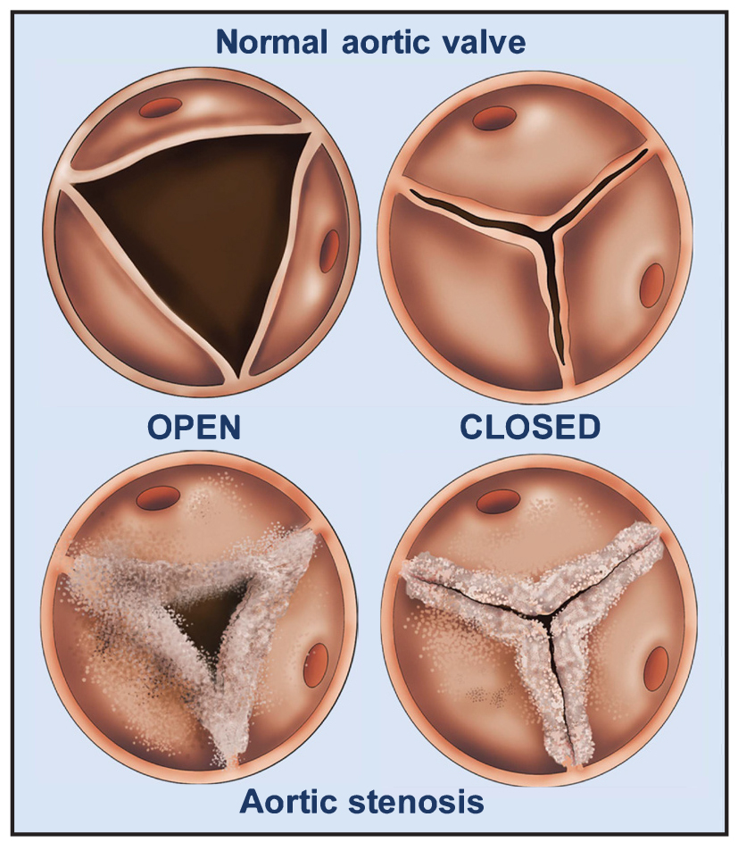 Illustration showing a normal aortic valve and a damaged aoritc valve - aortic stenosis