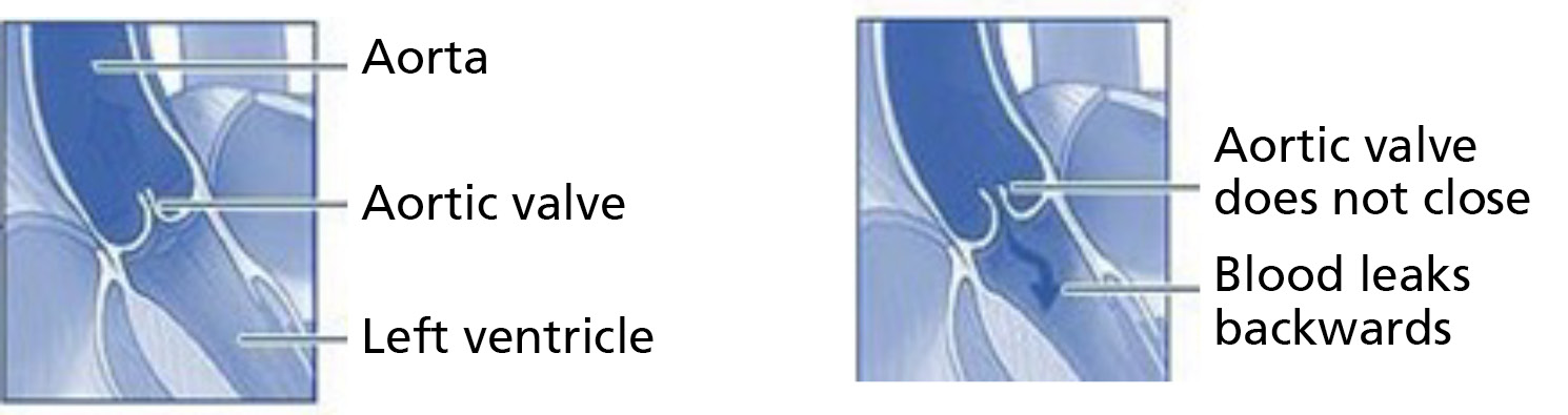 Aortic Regurgitation Leeds Teaching Hospitals Nhs Trust 5534