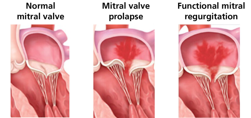 Illustrations showing what a normal mitral valve looks like compared to a mitral valve prolapse and a mitral regurgitation