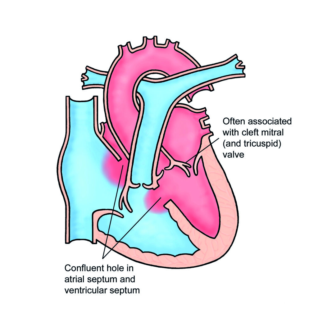 Repaired Atrioventricular Septal Defect (AVSD) - Leeds Teaching ...