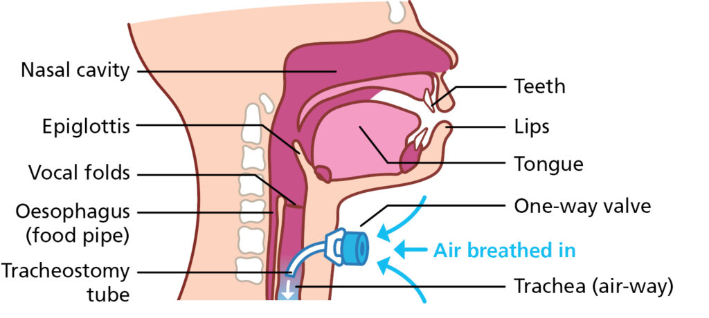 Anatomical illustration showing the air ways when breathing in with a one-way valve.