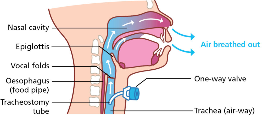 Anatomical illustration showing the air ways when breathing out with a one-way valve.