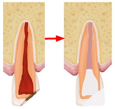 Image shows the closed end of the root canal