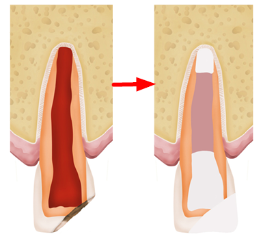 Image shows a barrier placed at the top of the root canal