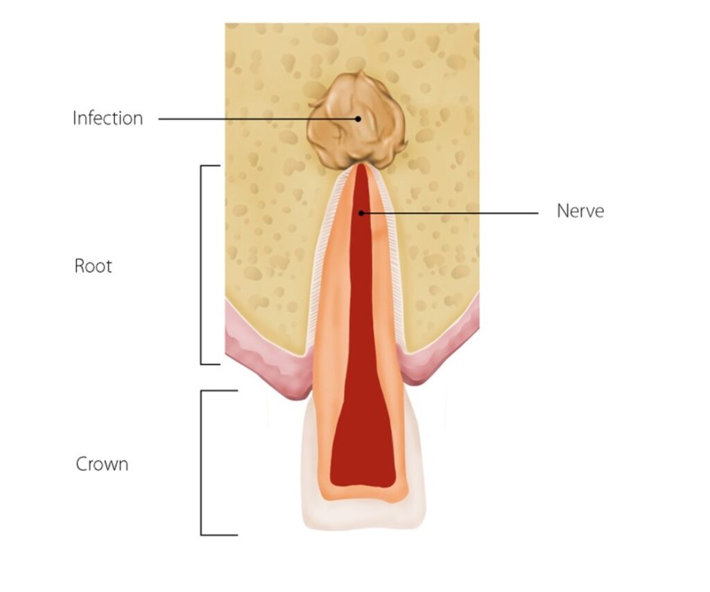 Picture shows an infection in the gum above the root canal of a tooth