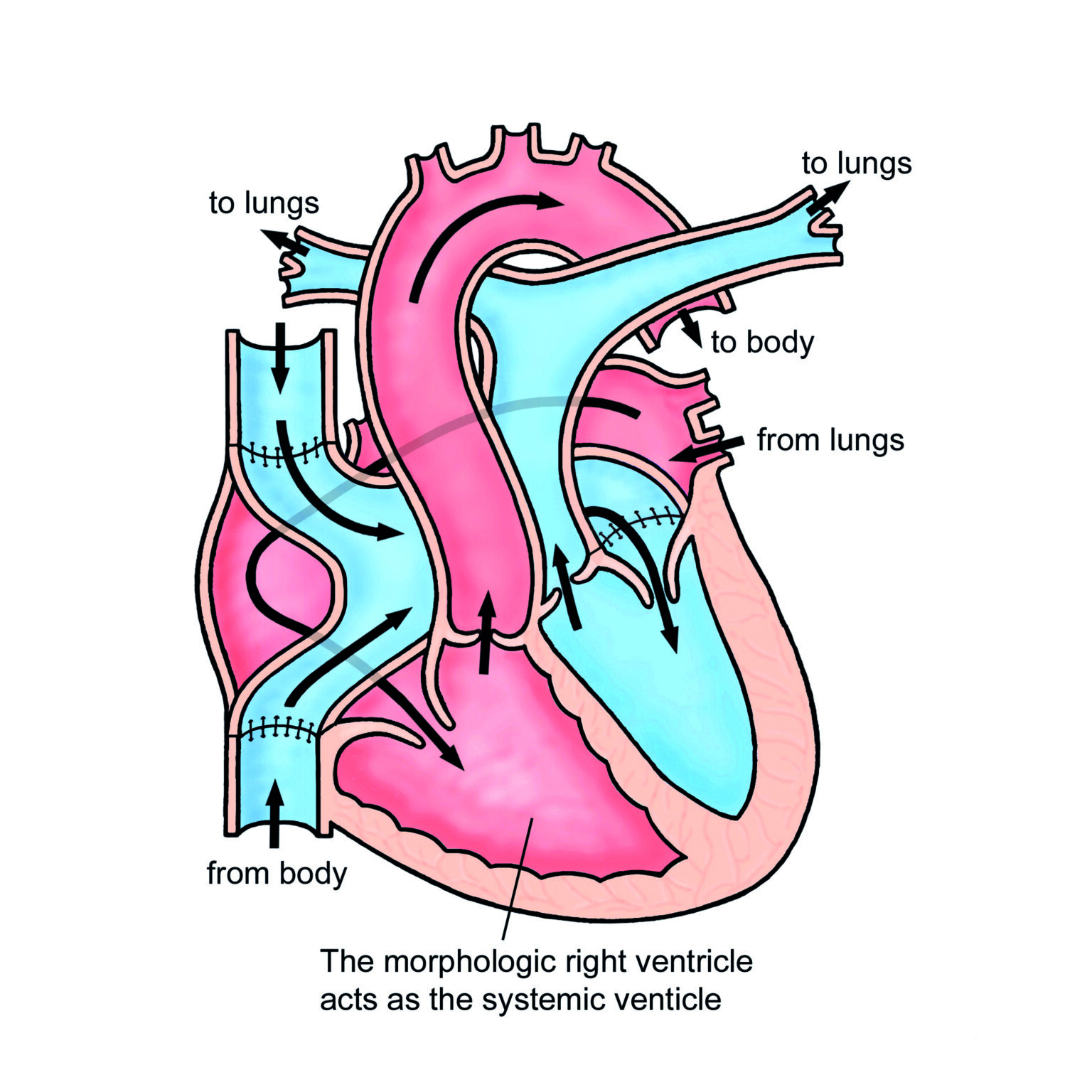 The Atrial Switch (Mustard or Senning) procedure for Transposition of ...