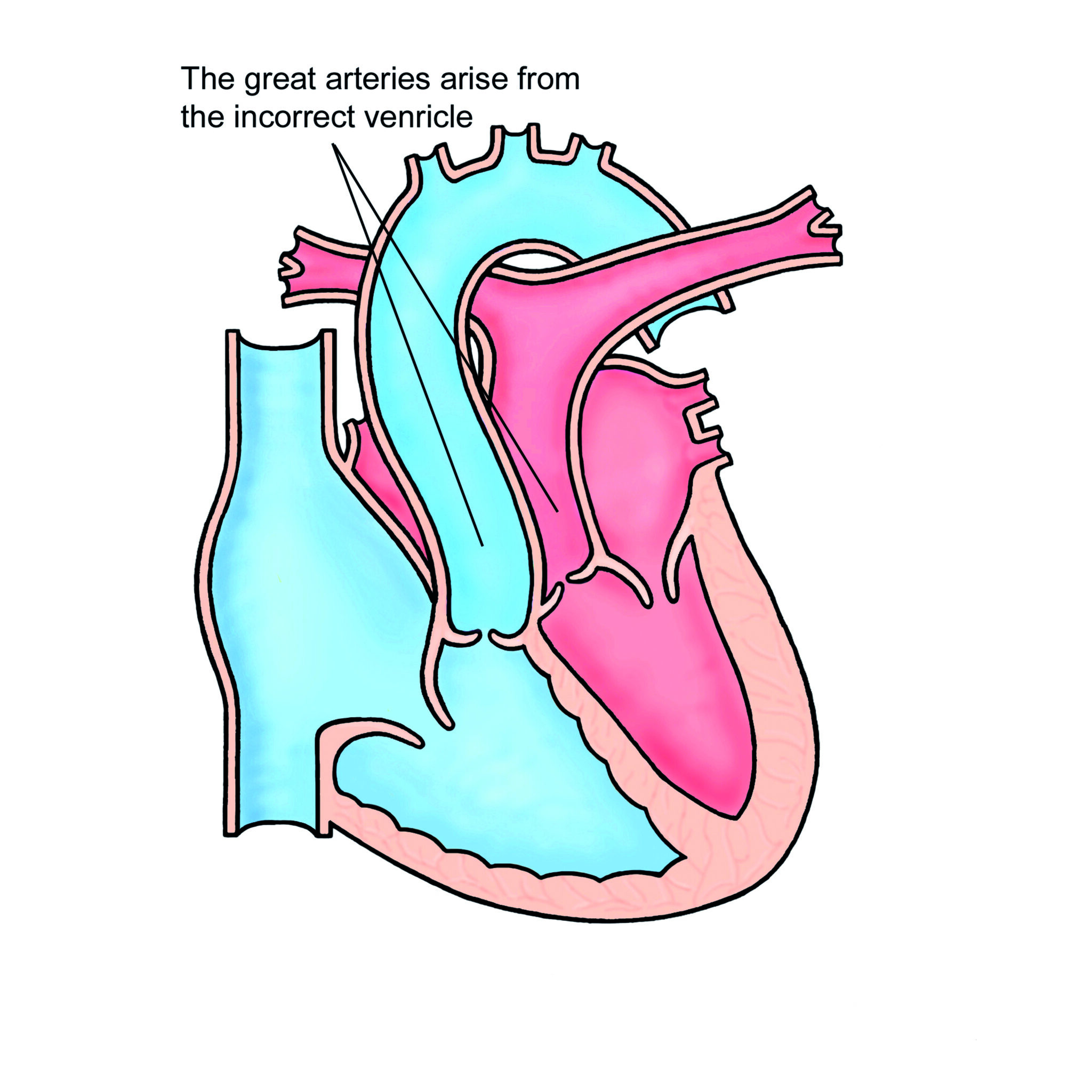 The Atrial Switch (Mustard or Senning) procedure for Transposition of ...