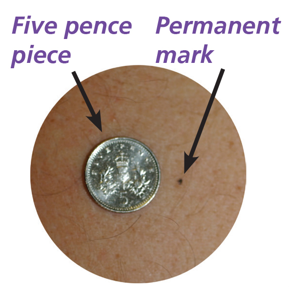 Photograph of a permanent mark next to five pence piece.