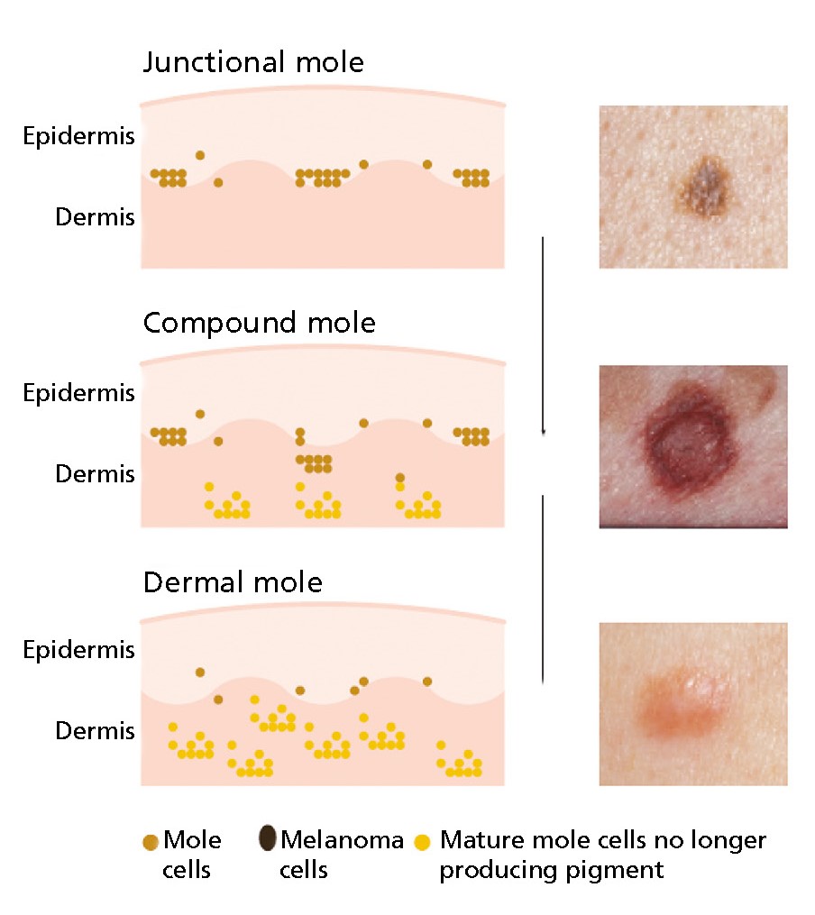 An image showing three different types of moles. Junctional moles, Compound moles and Dermal moles.