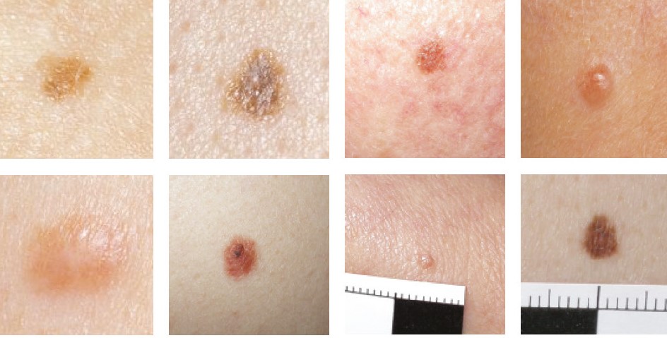 An image showing different types of normal moles