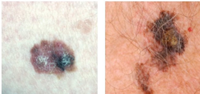 An image showing Melanomas growing laterally (sideways)