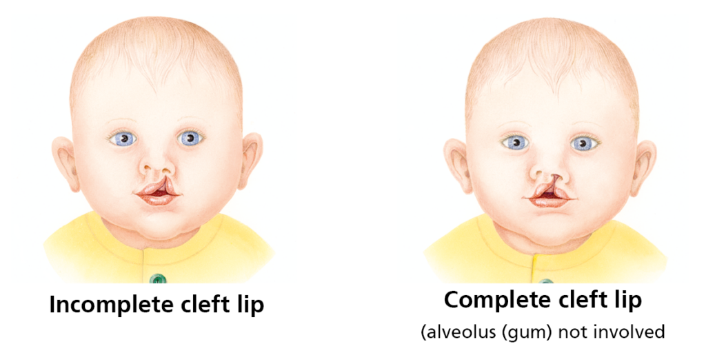 Cleft Lip - Leeds Teaching Hospitals NHS Trust