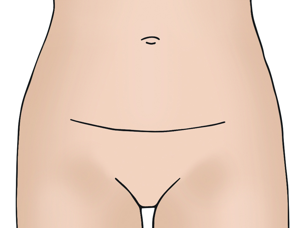 Illustration showing the open hysterectomy bikini line incision