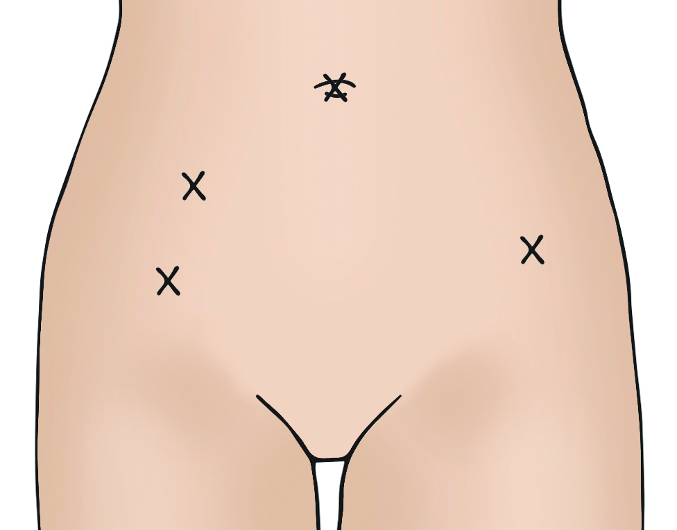 Illustration showing vaginal and vNOTEs hysterectomy incision site. 
This is scarless on the abdomen.