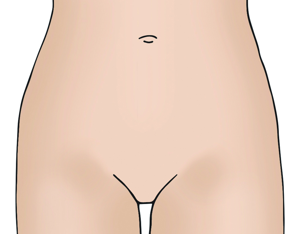 Illustration showing robotic hysterectomy incisions.