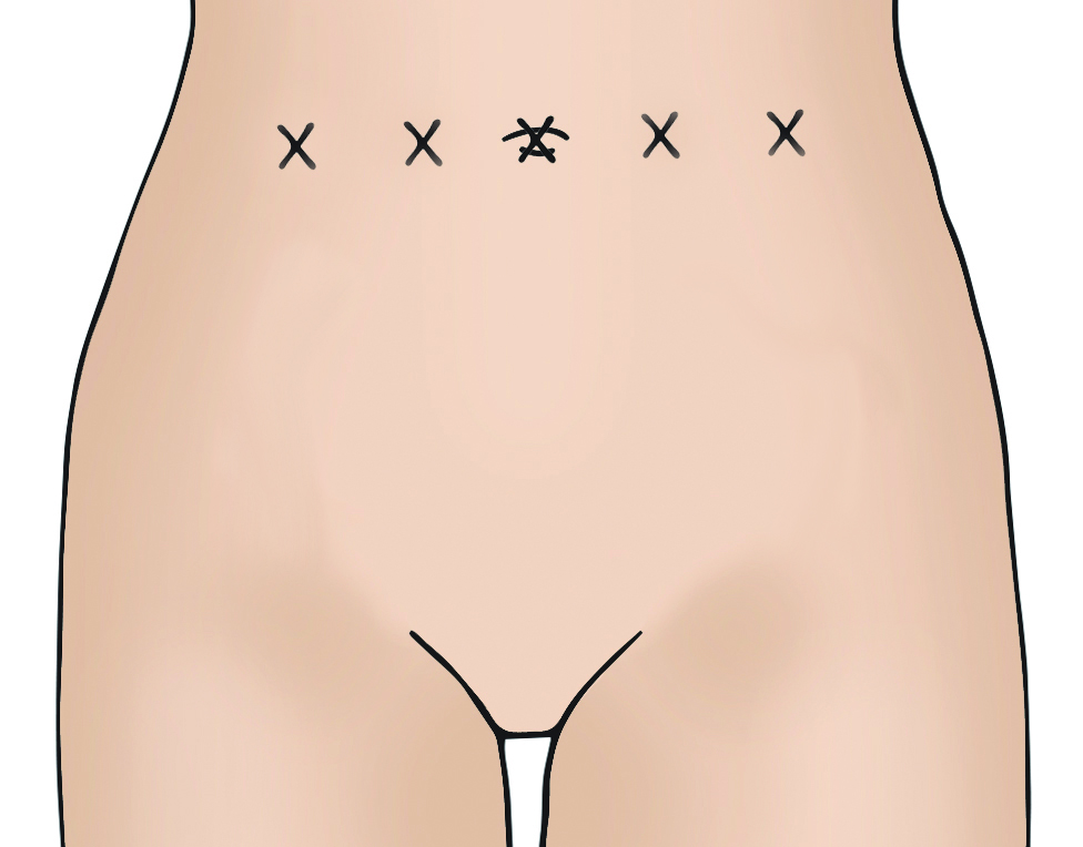 Illustration showing laparoscopic
(keyhole) incisions.