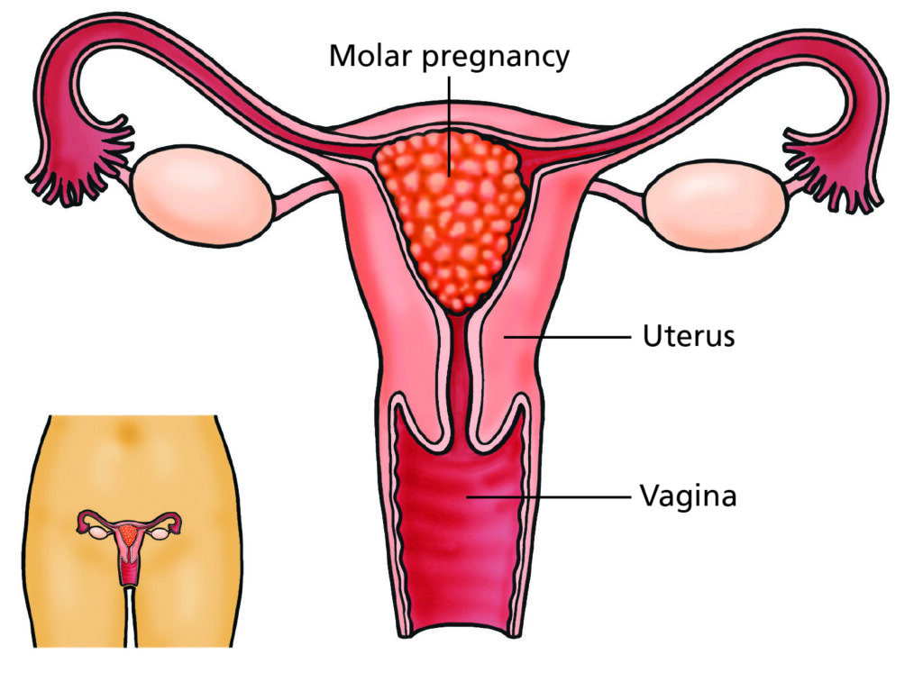 Illustration showing a molar pregnancy.