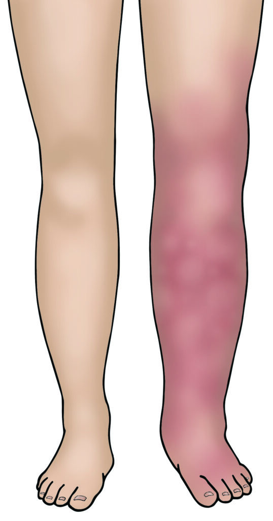 Image showing a blood clot in the leg (deep vein thrombosis) 