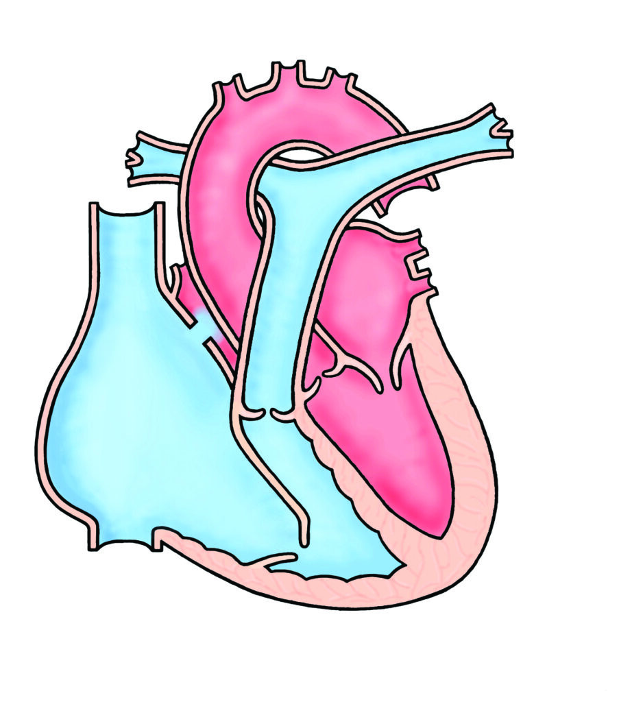 Illustration of a heart showing Ebstein's anomaly.