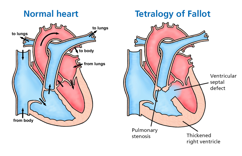 Illustration shows blood flow through a normal heart on the left and blood flow through a heart with Tetralogy of Fallot on the right. You can see the blood flowing through the ventricular septal defect in the centre of the heart. 