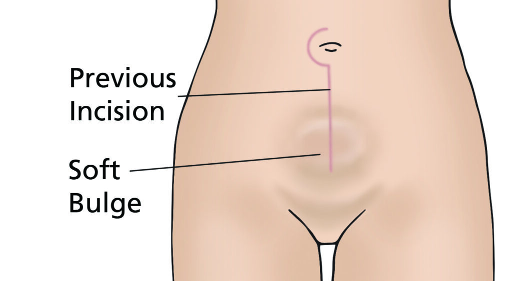 Image showing an incisional hernia