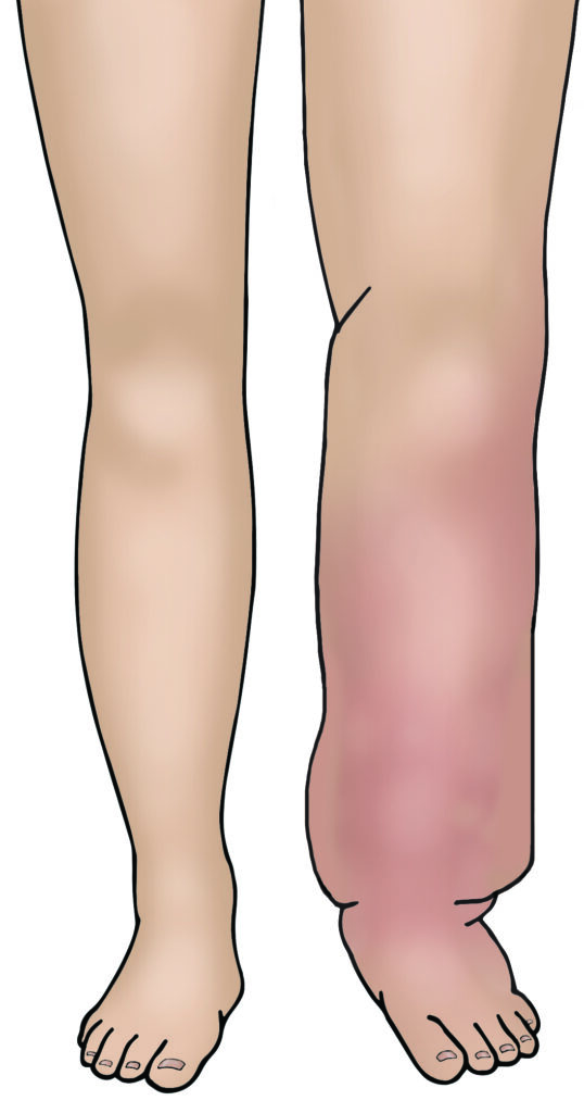 Image showing a Lymphoedema.