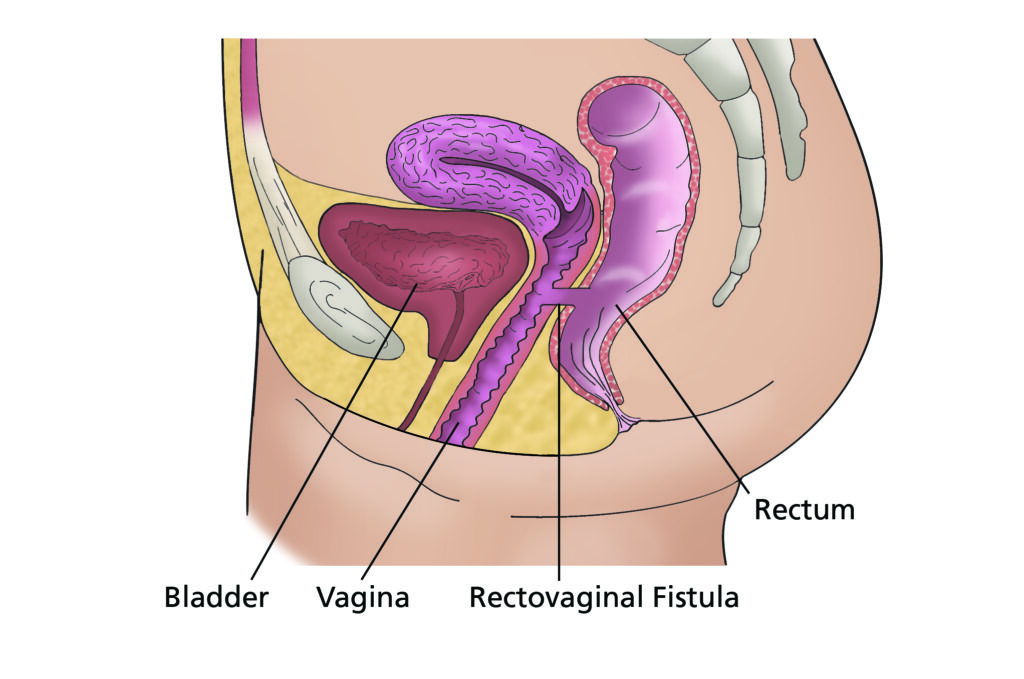 Image showing a rectovaginal fistula.