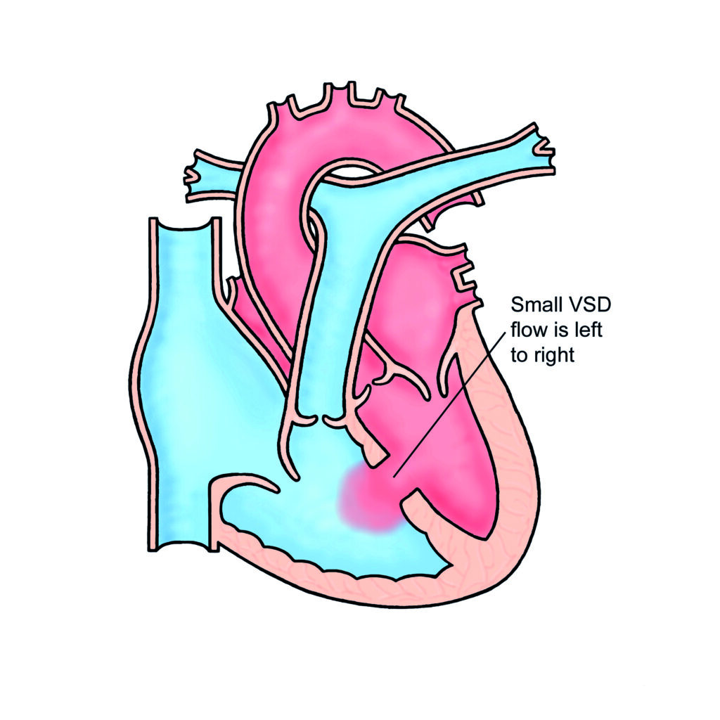 Image of a heart with a Small Ventricular Septal Defect (Muscular)