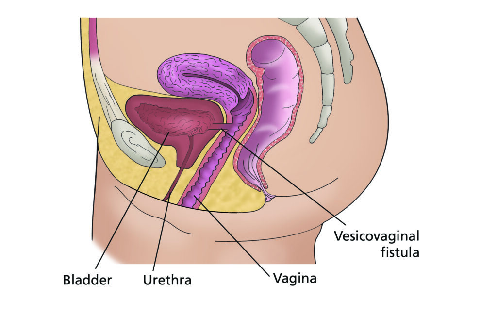 Image showing a vesicovaginal fistula.