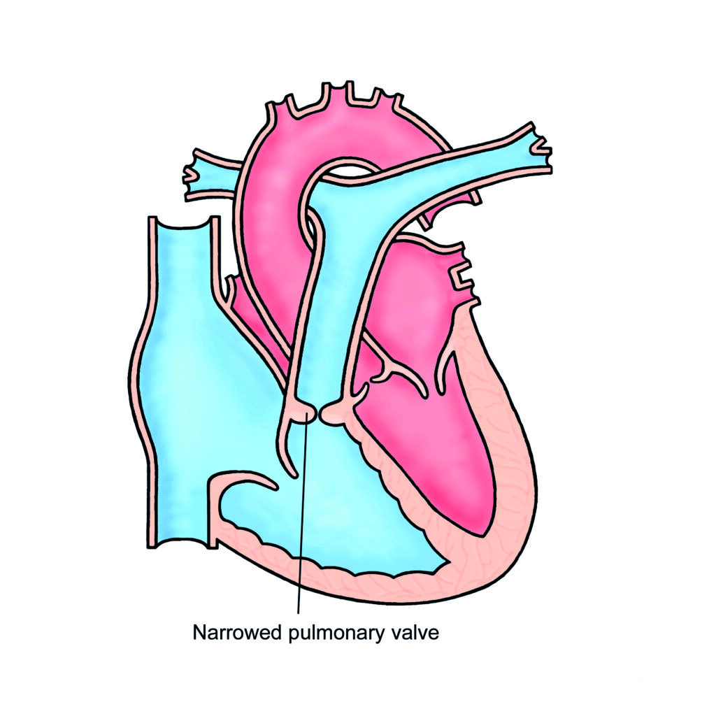 Image of a heart with Pulmonary Stenosis