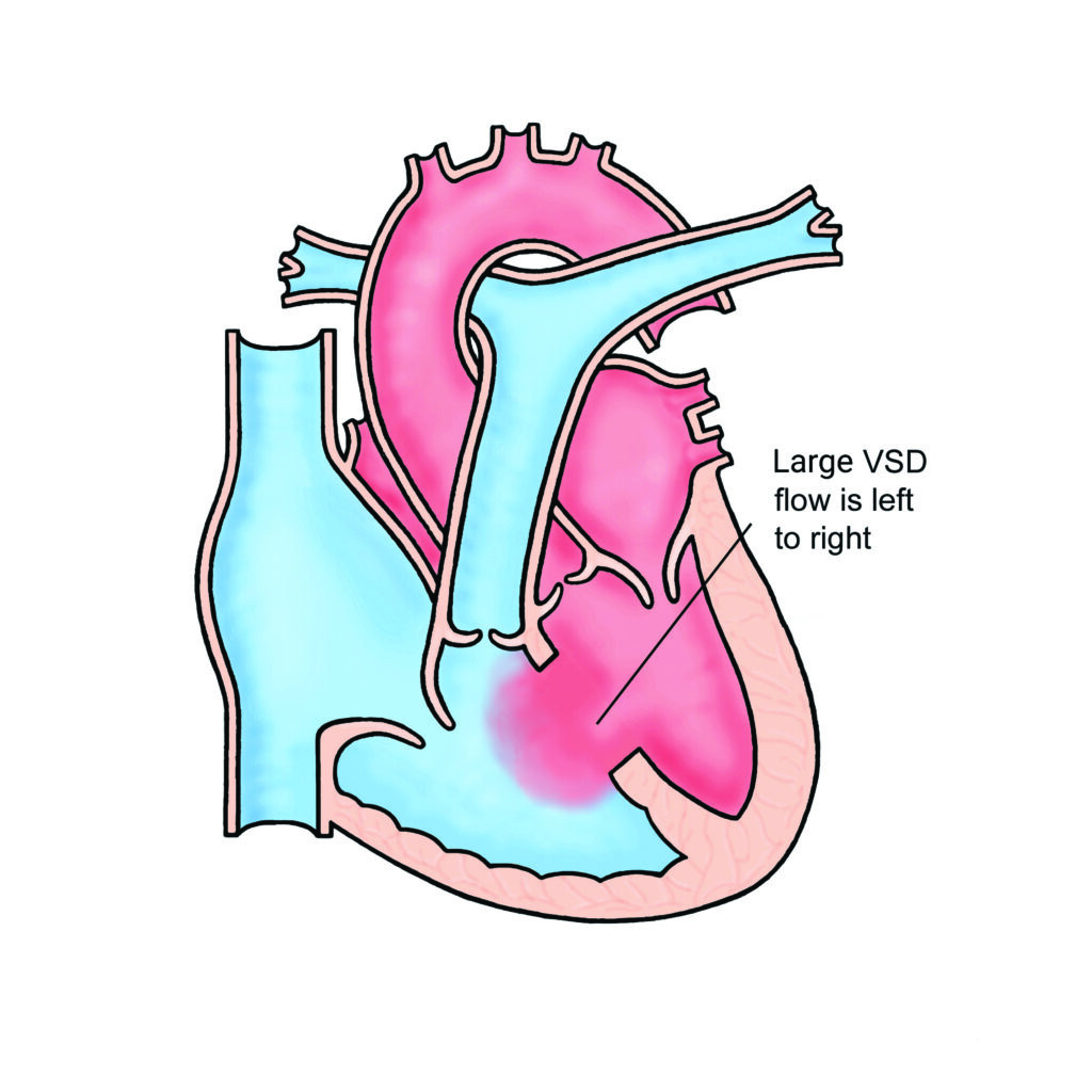 Image of a heart with Ventricular Septal Defect (Large)