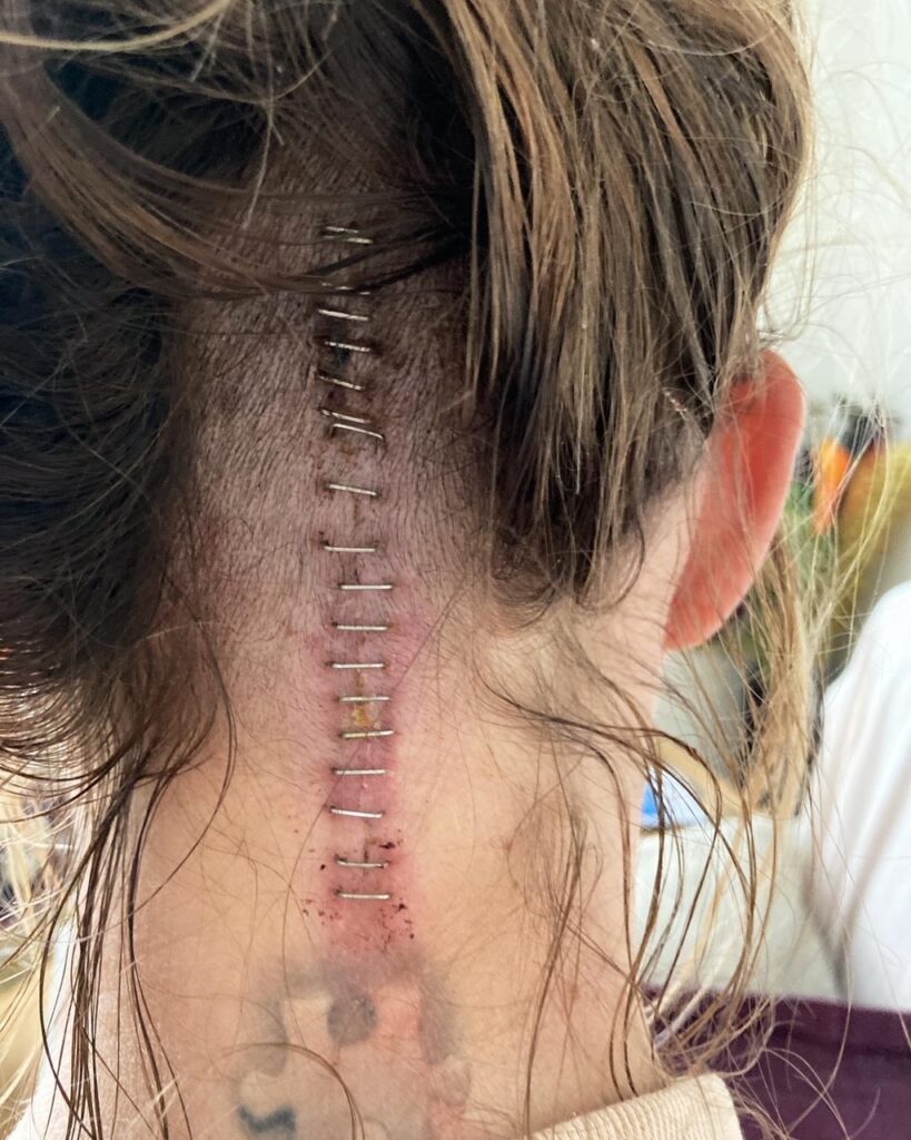 The large scar and stitches running up the back of Mel's neck and head. 